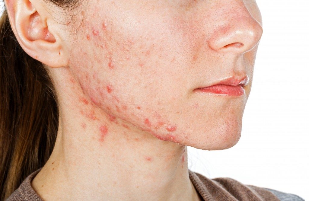 face acne